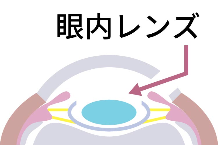 眼内レンズの挿入