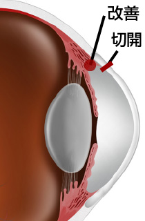 線維柱帯切開術のイメージ写真
