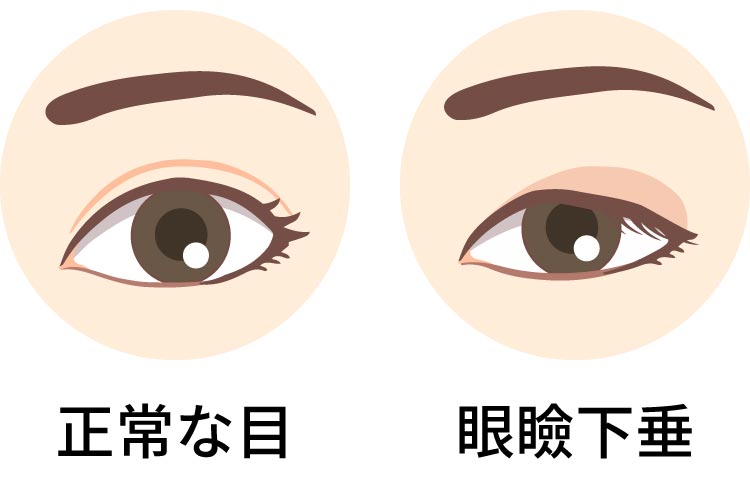 眼瞼下垂のイメージ画像
