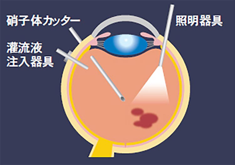 硝子体手術の治療のイメージ画像